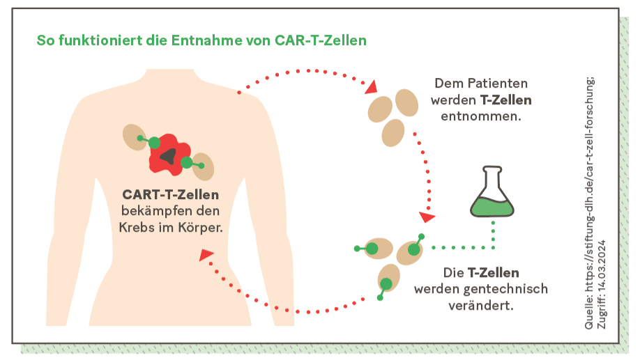 Grafik: So funktioniert die Entnahme von CAR-T-Zellen
