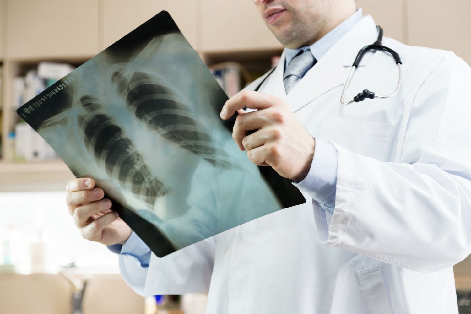 Ein Arzt wirft einen Blick auf eine Aufnahme einer Patientenlunge. Thema: Lungenkrebs